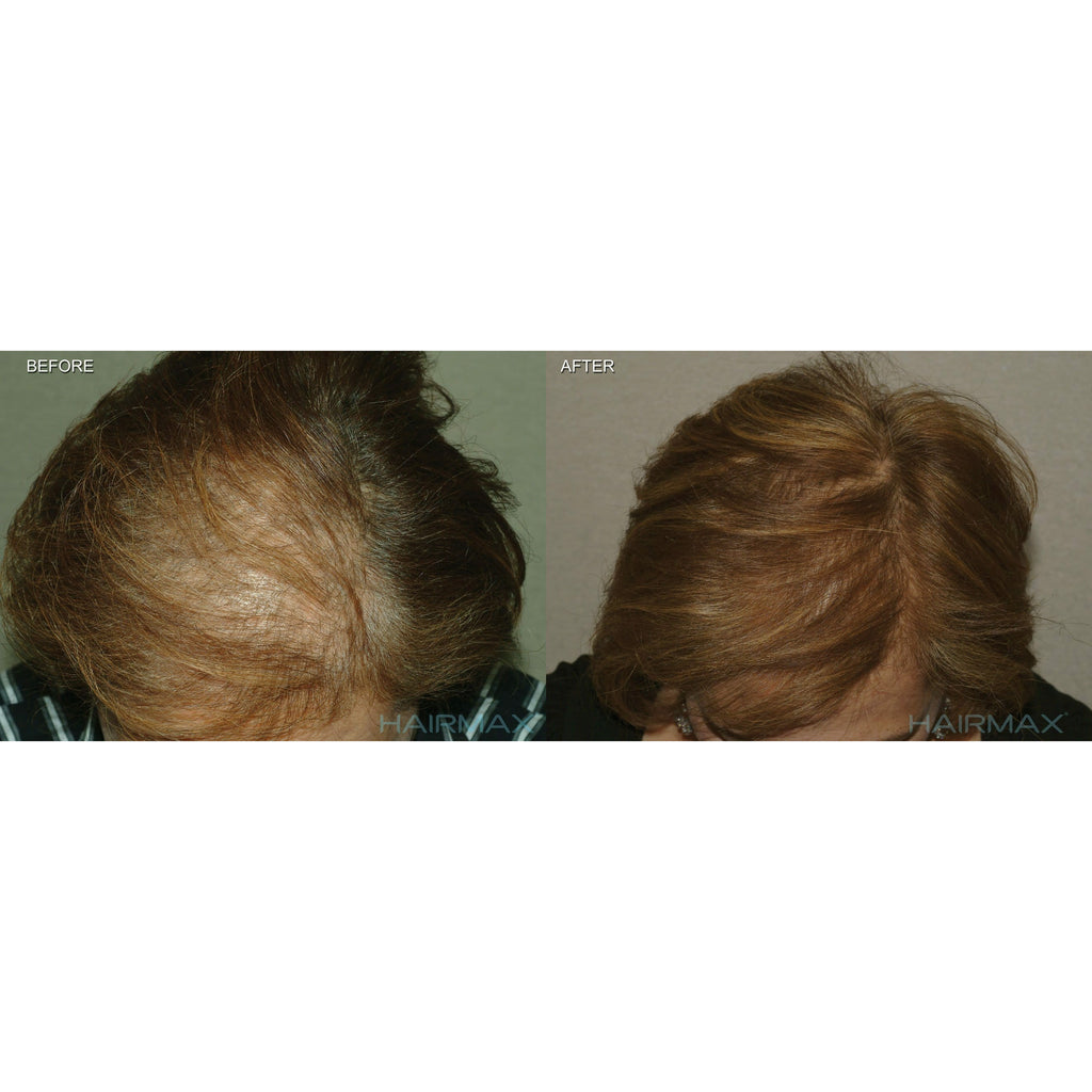 LaserBand 82 Comfort Flex - HairMax | Re-vokse håret med den ultimate laserbehandling | HairMax Laser 272 PowerFlex Cap