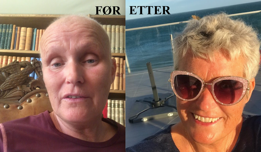 Elisabeth fra Bergen ble rammet av kreft - fikk håret tilbake med HairMax