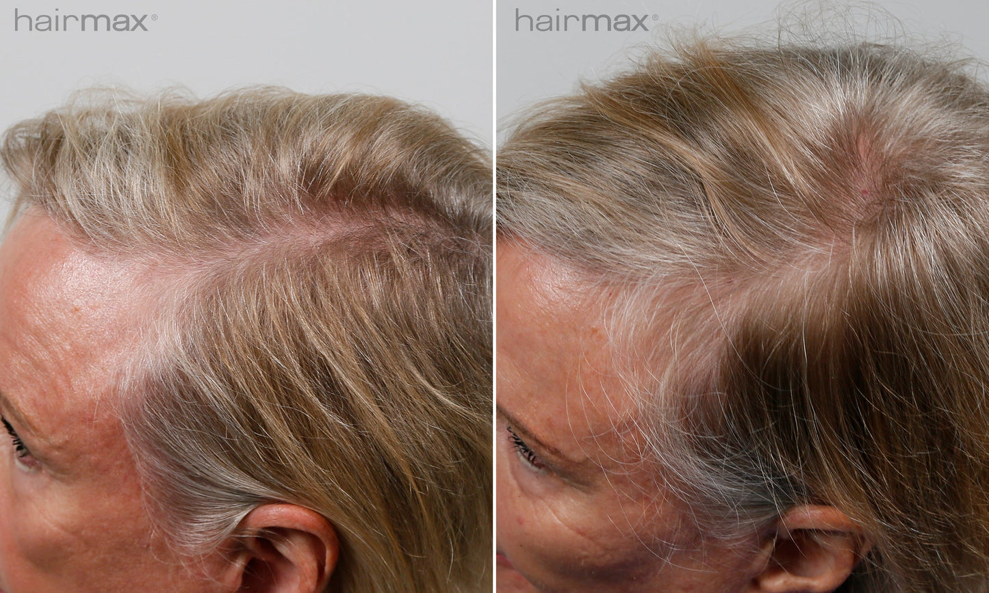 Før og etter 6 måneders bruk av HairMax. Individuelle resultater varierer.