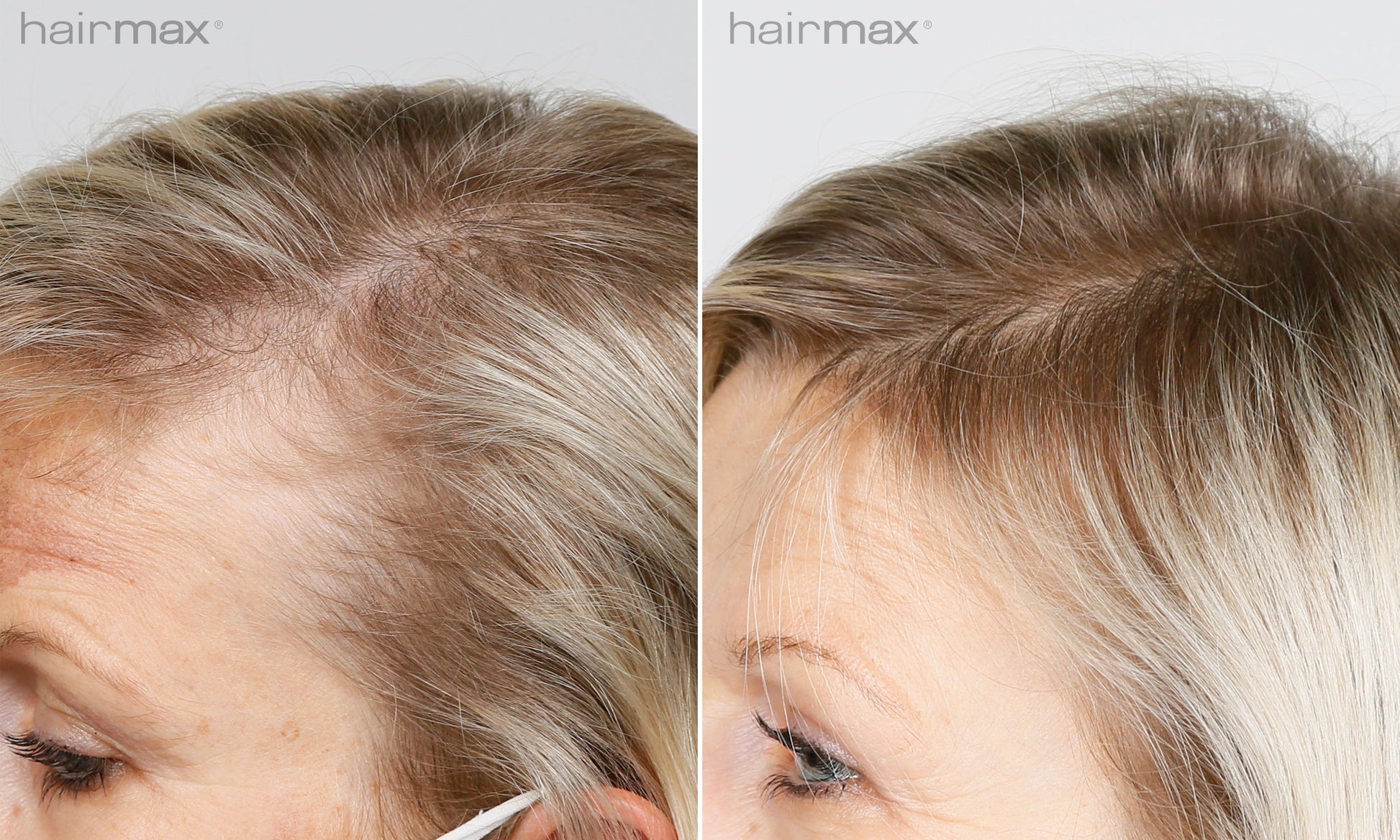 Før og etter 6 måneders bruk av HairMax. Individuelle resultater varierer.