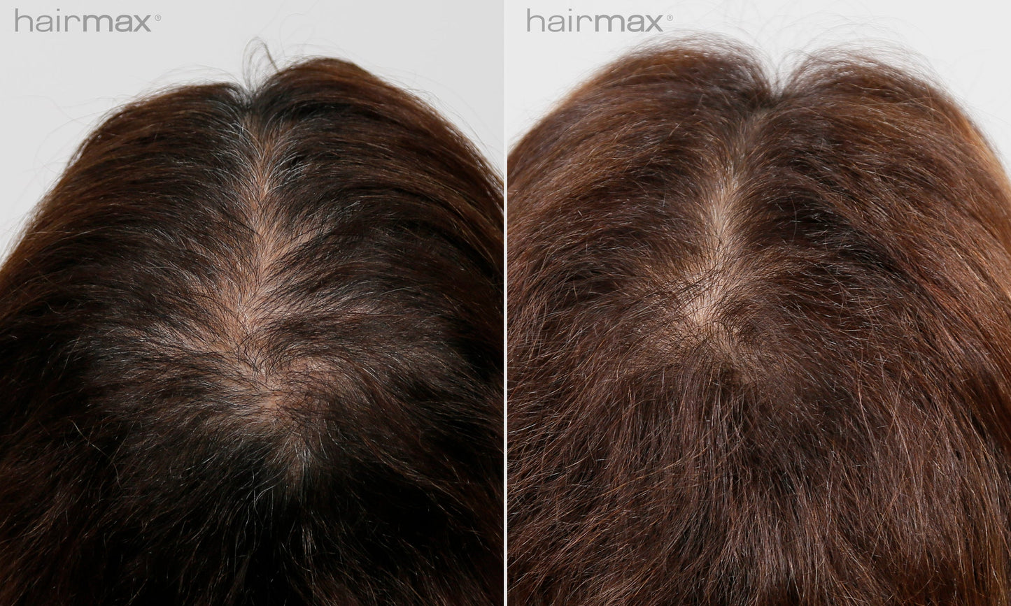 Før og etter 6 måneders bruk av HairMax. Individuelle resultater varierer.