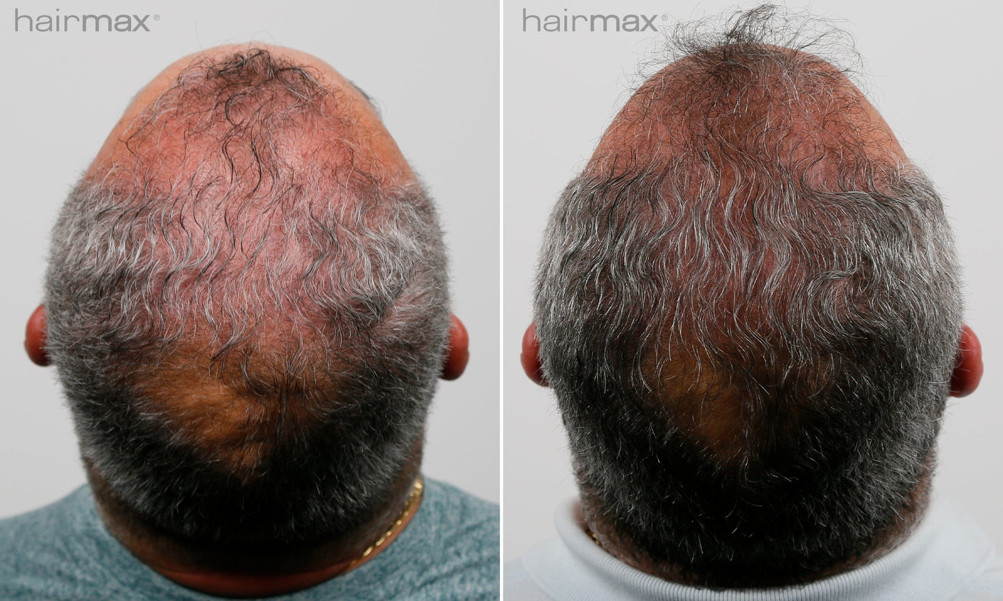Før og etter 6 måneders bruk av HairMax. Individuelle resultater varierer.
