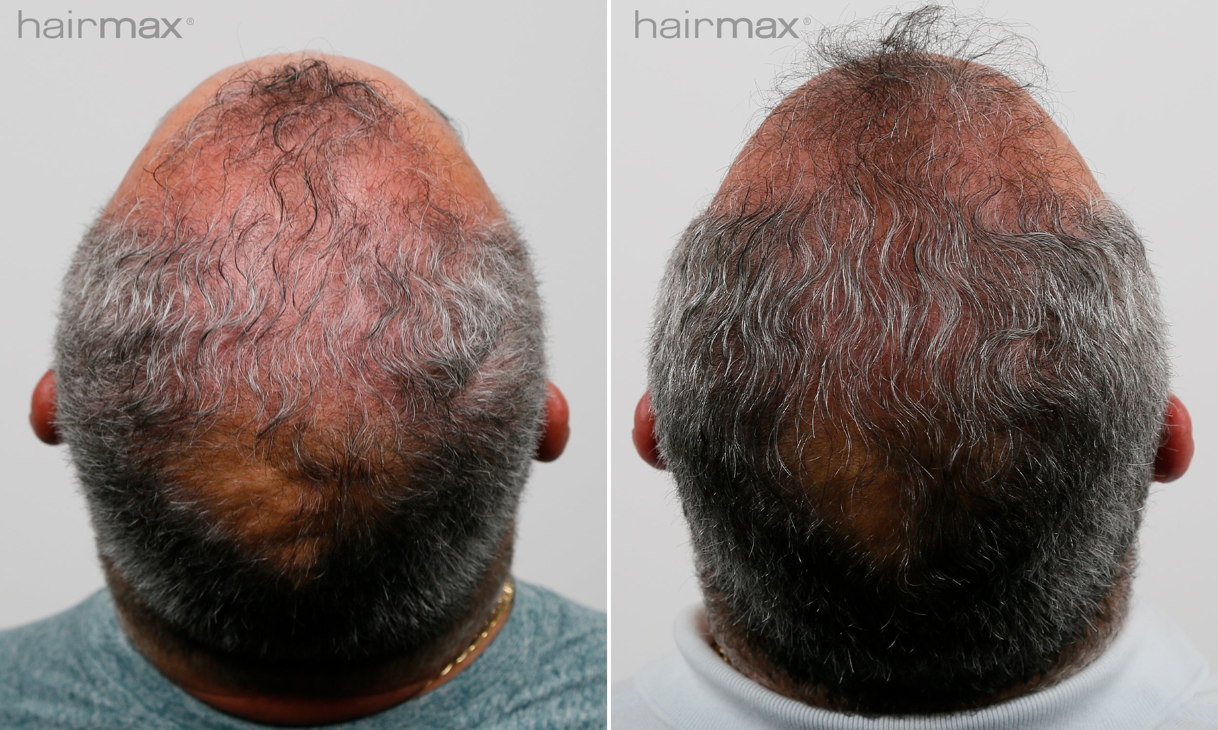 Før og etter 6 måneders bruk av HairMax. Individuelle resultater varierer.