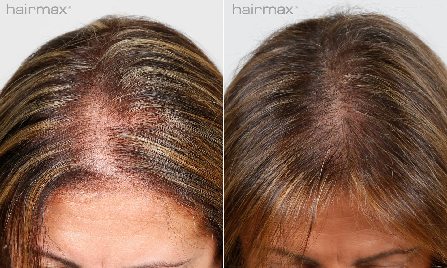 Før og etter 6 måneders bruk av HairMax. Individuelle resultater varierer.