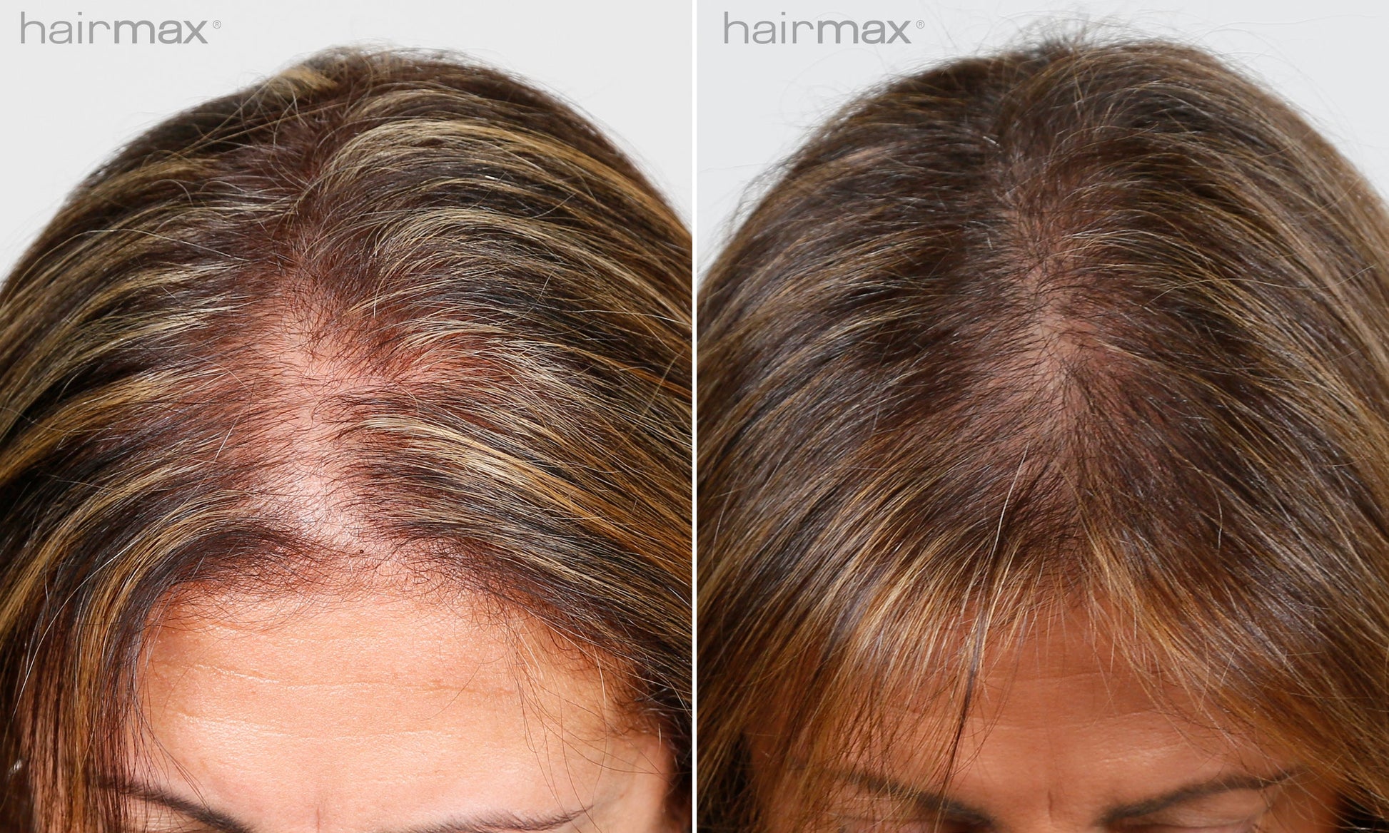 Før og etter 6 måneders bruk av HairMax. Individuelle resultater varierer.