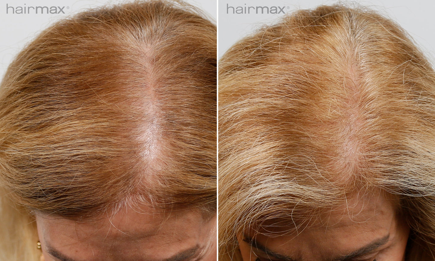 Før og etter 6 måneders bruk av HairMax. Individuelle resultater varierer.