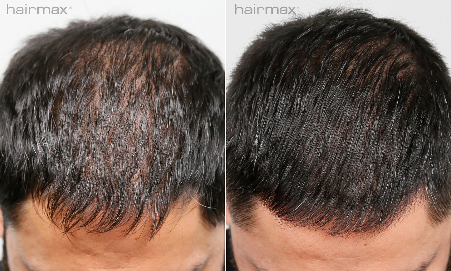 Før og etter 6 måneders bruk av HairMax. Individuelle resultater varierer.