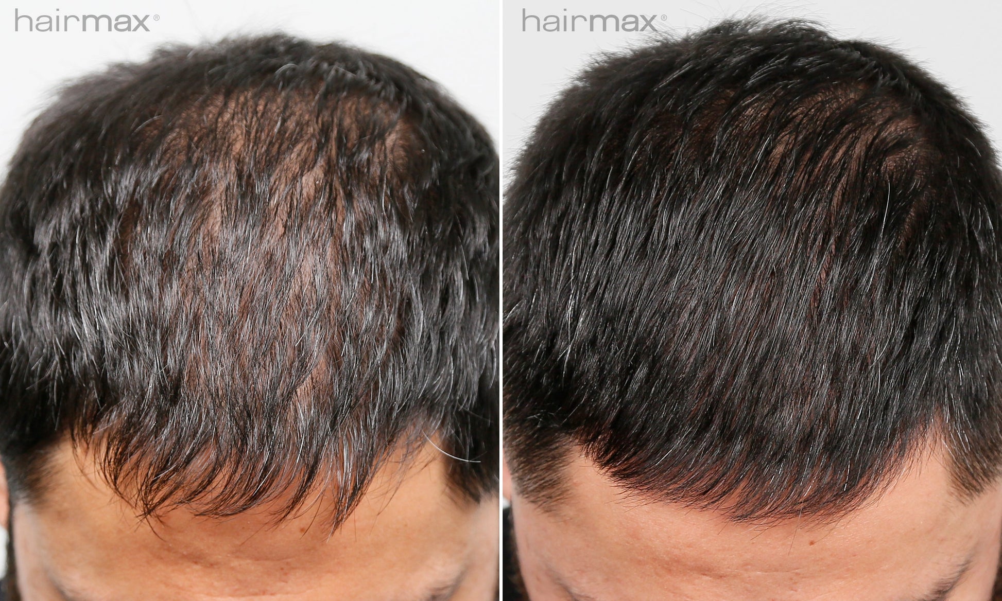 Før og etter 6 måneders bruk av HairMax. Individuelle resultater varierer.