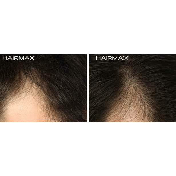 HairMax Ultima 12 - HairMax | Re-vokse håret med den ultimate laserbehandling | HairMax Laser 272 PowerFlex Cap