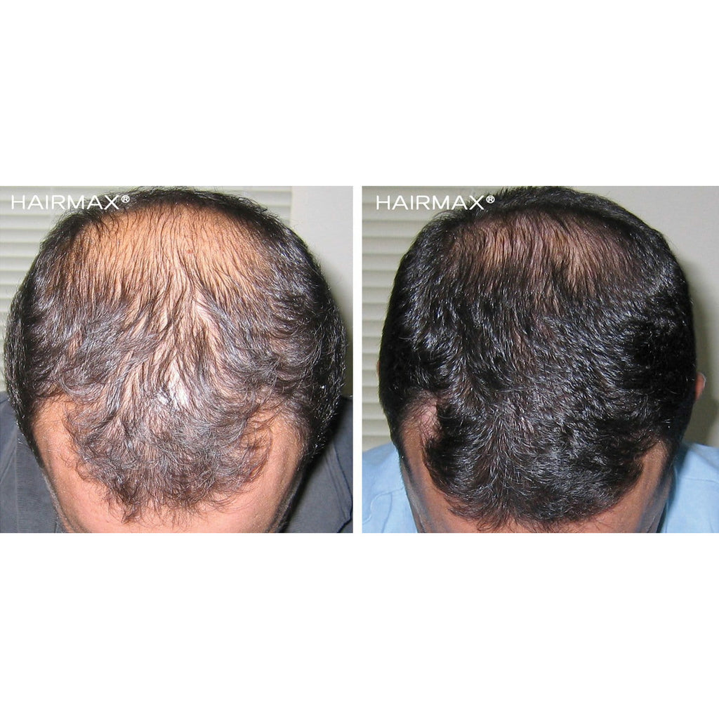 Laser 272  PowerFlex Cap - HairMax | Re-vokse håret med den ultimate laserbehandling | HairMax Laser 272 PowerFlex Cap